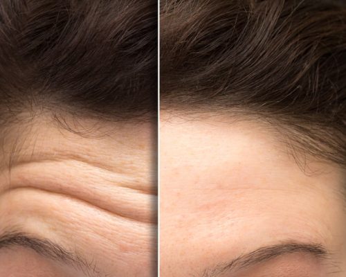 shutterstock_1706757901 before & after forehead lines